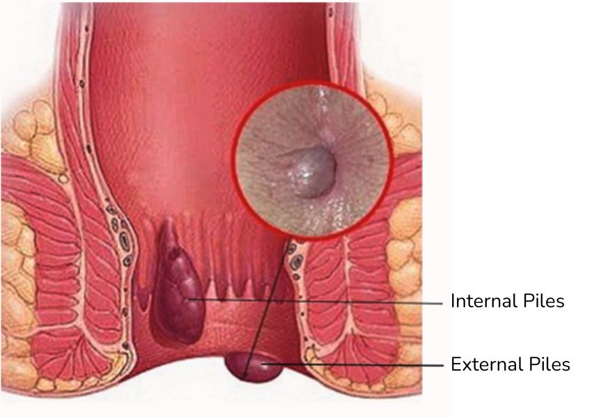 Internal and external piles explained by Dr. Swarupjit Ghata